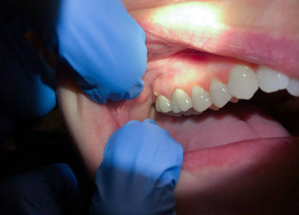 Best Lost Filling or Crown Replacement in Mercer, PA